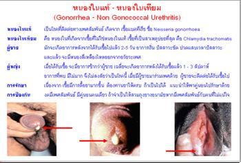 ใบความรู้ 18 หนอในแท้ หนองในเทียม.JPG