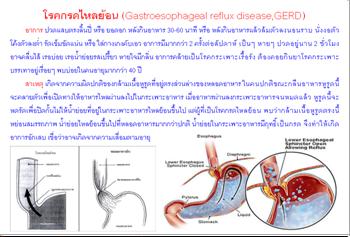 ใบความรู้ 16 โรคกรดไหลย้อน.JPG