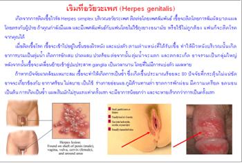 ใบความรู้ 15 เริมที่อวัยวะเพศ.JPG