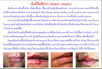 ใบความรู้ 14 เริมที่ริมฝีปาก.JPG