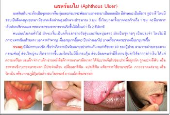 ใบความรู้ 10 แผลร้อนใน.JPG