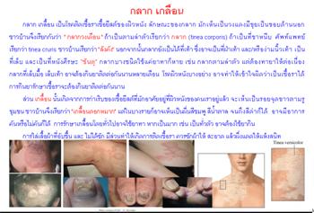 ใบความรู้ 4 กลากเกลื้อน.JPG