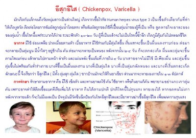 ใบความรู้ 37 อีสุกอีใส.JPG