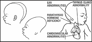 accutane_birth_defects.gif